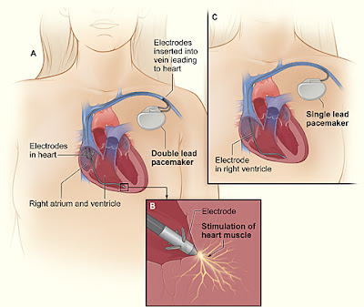 pacemaker