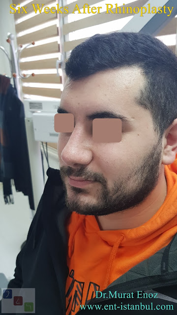 Male nose job Turkey. Nose aesthetic surgery for men,Rhinoplasty in Men Istanbul,