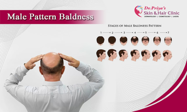 Best Male Pattern Baldness In Bangalore