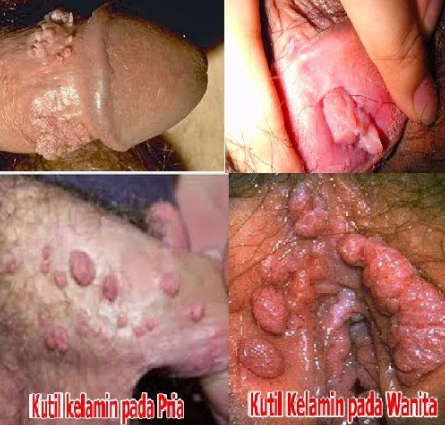 obat kutil kelamin perempuan