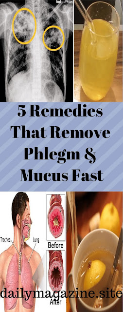 5 Remedies That Remove Phlegm & Mucus Fast