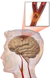 Pengobatan Stroke Dengan Cara Alami