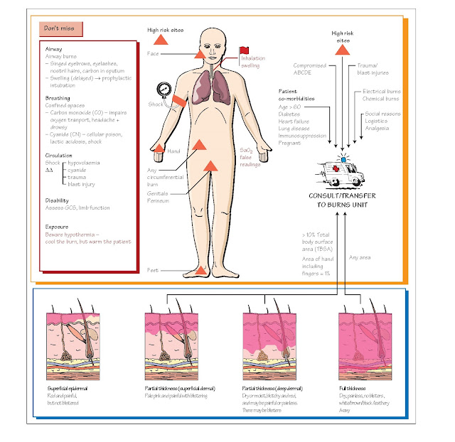 Burns, The burn, Intravenous fluids, Minor burns, Chemical burns, 