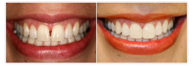 Healthy Home Living Teeth Gap Bands  bringing the smile 