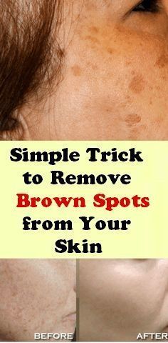 Simple Trick to Remove Brown Spots from Your Skin