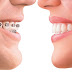 Phương pháp niềng răng hô móm như thế nào?