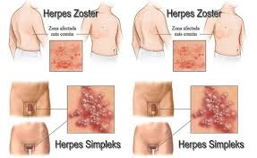 Ciri-ciri Penyakit Herpes