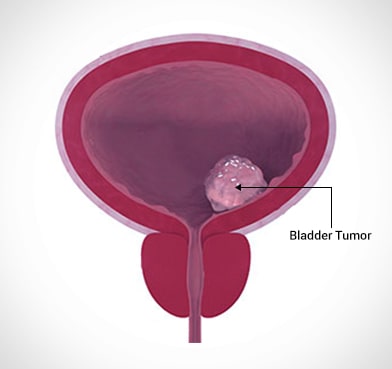 Bladder Cancer Surgery in Delhi