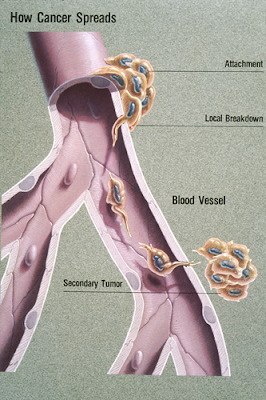 cancer, metastases, metastasis, spread, blood vessel, secondary cancer, biology