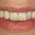 Nguyên nhân răng bị ố vàng không nên bỏ qua