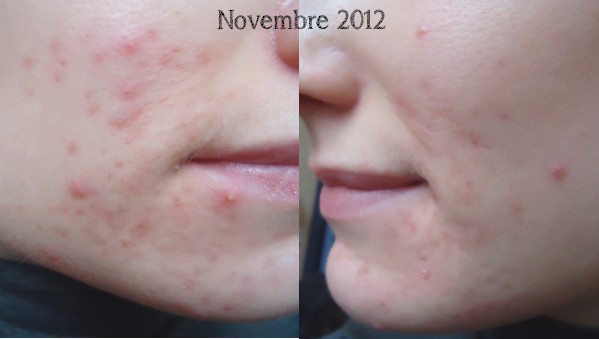 My beauty moment: L'acné : mon parcours - un an de bataille