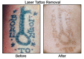 laser removal 