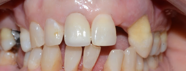 After Bonding of Dental Crown on Central Incisor