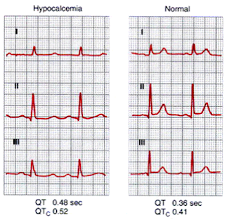 ECG changes in Acute Hypocalcemia
