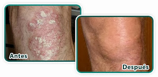 Elimine la Psoriasis