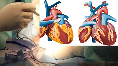 What Is Heart Transplantation