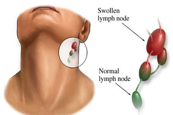 Swollen Lymph Nodes and its impact