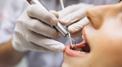 Tìm hiểu về bệnh viêm chân răng có mủ 2