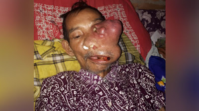 Buruh Tani Di Simalanggang Ini Diserang Kanker Ganas Di Rongga Hidung