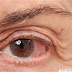 Bệnh Glaucoma, kẻ thù nguy hiểm với mắt