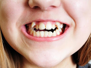 Niềng răng cho trẻ em ở đâu tốt tphcm-1