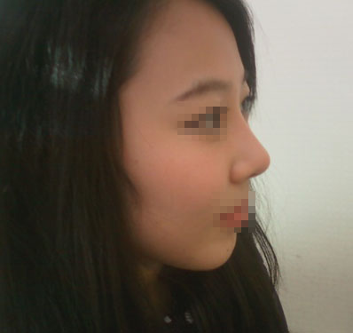 짱이뻐! - My Image Is Getting Softer After Korea Rhinoplasty