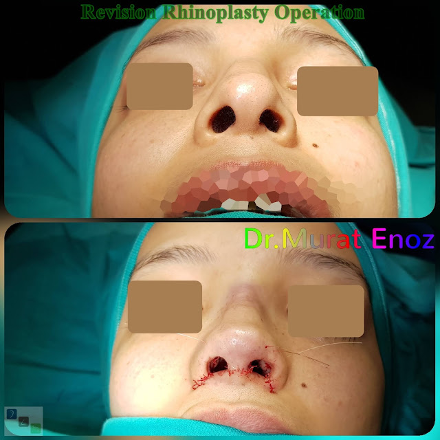 Revision Rhinoplasty Operation in Istanbul, Ethnic Revision Nose Job Turkey