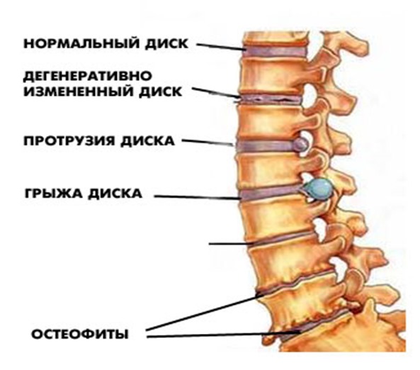 bolezni_pozvonohnika