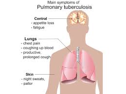 Infection of TB - Tuberculosis