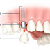 Lợi ích khi trồng răng Implant