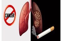 Lung Cancer Definition