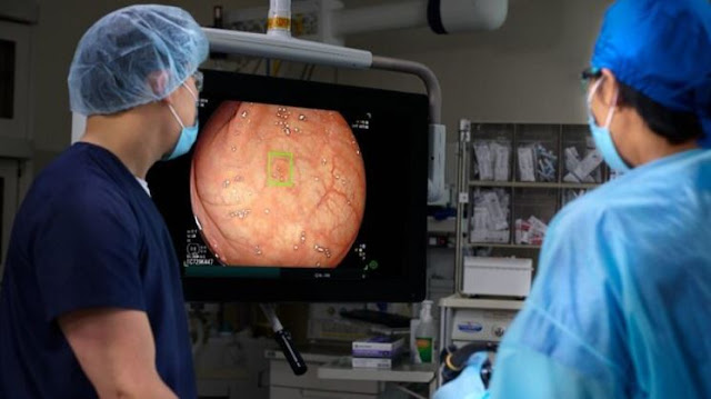 AI-Powered Colonoscopy: A Breakthrough in Cancer Detection