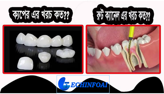 রুট ক্যানেল খরচ সম্পর্কিত তথ্য