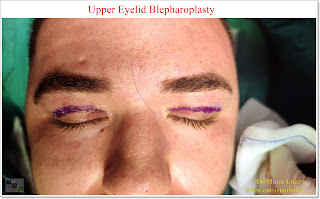 Blepharoplasty,Droopy eyelid surgery,Upper eyelid surgery, in Istanbul, Cost