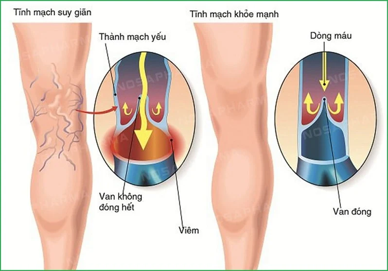 Tĩnh mạch suy yếu