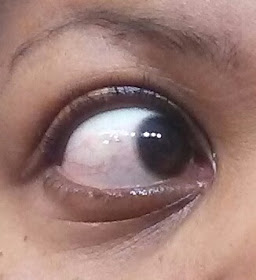 blister in eyeball