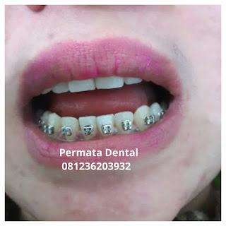 gambar foto behel bracket kawat gigi sebelum dan sesudah perawatan untuk memperbaiki merapikan gigi gingsul gigi miring renggang tonggos berantakan keluar masuk jarang diastema maju mundur tidak rapi tidak beraturan bali denpasar banyuwangi jember tidak rata kocar kacir