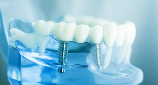 Global Dental Implants Market size