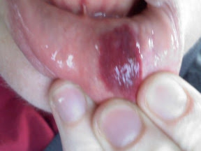 Blister In My Mouth - Mouth Blisters: What are the causes of blisters in the ... / Finding blisters in mouth tissue isn't unusual;