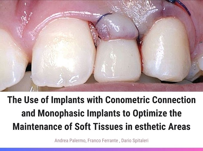 PDF: The Use of Implants with Conometric Connection and Monophasic Implants to Optimize the Maintenance of Soft Tissues in esthetic Areas