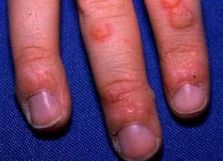 Warts on Fingers