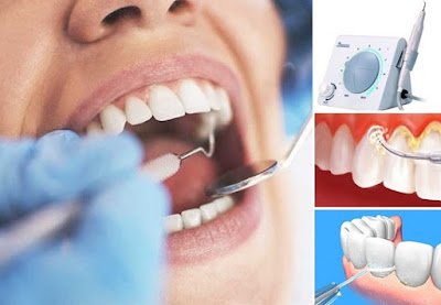 Cạo vôi răng bằng cách nào an toàn hiệu quả? 2