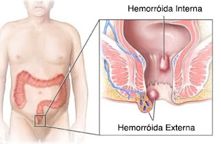 Doença Hemorroidária