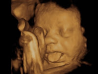 3d Sonogram