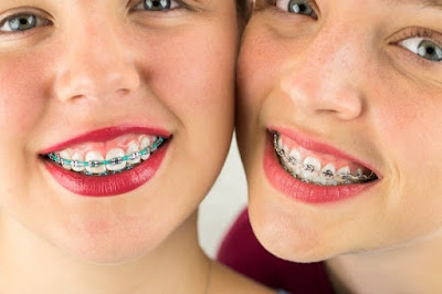 Định nghĩa niềng răng móm là gì?