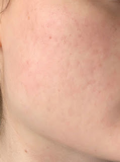Image of my current acne scarring and texture