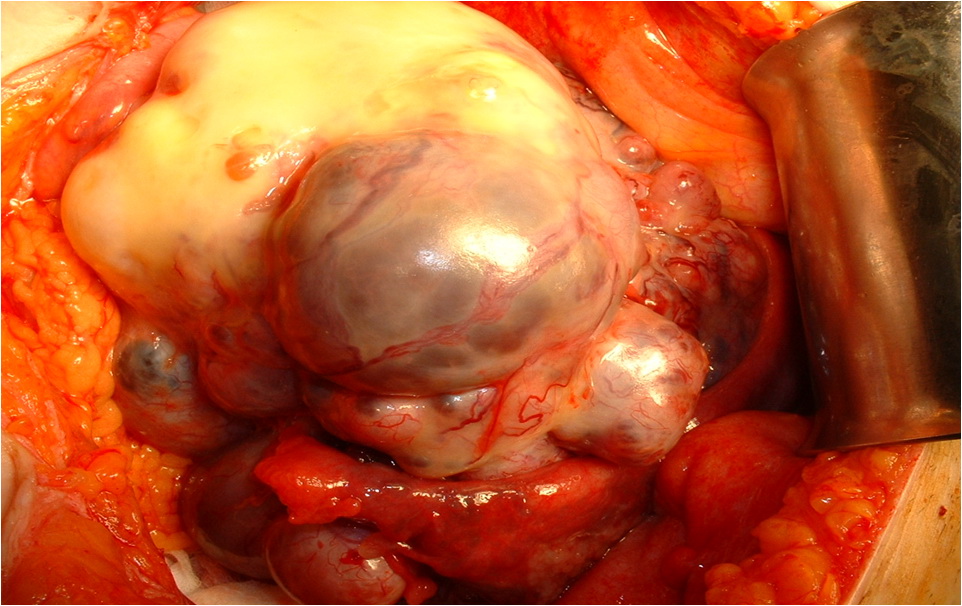 Disease Ovarian Polycystic Ovary Syndrome