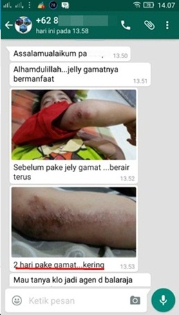 Cara Mengobati Kulit Gatal Perih Karena Herpes