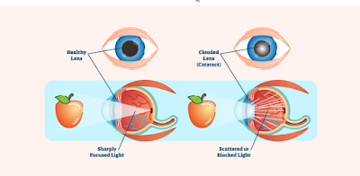 best eye surgeon,cataract surgery,cataract specialist,cheap cataract surgery, cataract surgery cost in mumbai,cataract symptoms,free cataract surgery