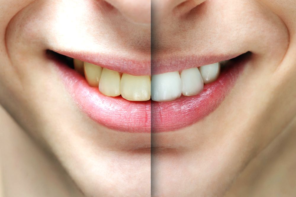 teeth-whitening